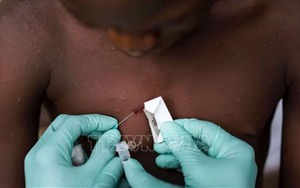 Các nước khẩn trương ứng phó bệnh đậu mùa khỉ