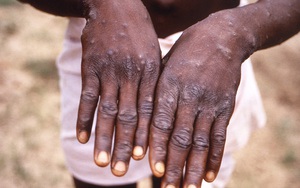 WHO: Bệnh đậu mùa khỉ đã lan ra 30 quốc gia