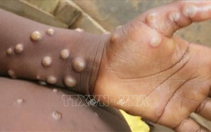 Những thông tin sai lệch về bệnh đậu mùa khỉ