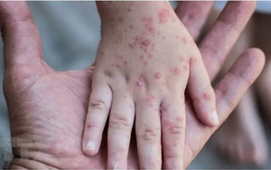 WHO ghi nhận hơn 5.300 ca bệnh đậu mùa khỉ trong 6 tháng đầu năm 2022