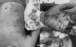 Bé trai 10 tuổi bị đa chấn thương do nổ pin điều khiển đồ chơi​