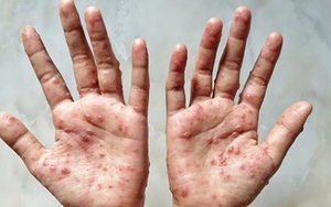 Hà Nội sẵn sàng đáp ứng khi có ca bệnh nghi ngờ đậu mùa khỉ