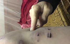 Chủ tịch Hà Nội yêu cầu điều tra, xử lý vụ việc bé trai 9 tuổi bị cha đẻ bạo hành