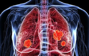 Tỷ lệ nữ giới châu Á không hút thuốc mắc ung thư phổi tăng