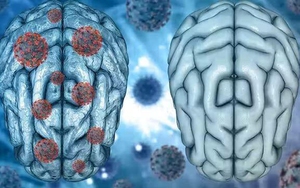 Chuyên gia giải mã nguyên nhân gây 'sương mù não' hậu Covid-19