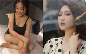 Hương Tràm bị buộc nghỉ hát vì dị ứng cấp tính, nổi mẩn khắp người