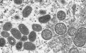 Anh ghi nhận các trường hợp mắc đậu mùa khỉ trong cộng đồng