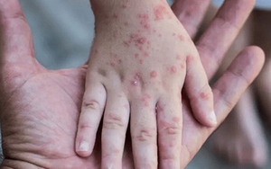 WHO chưa coi đậu mùa khỉ là tình trạng khẩn cấp y tế toàn cầu