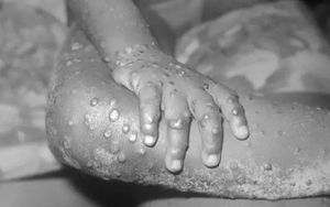 WHO bỏ phân loại quốc gia bệnh đặc hữu với đậu mùa khỉ