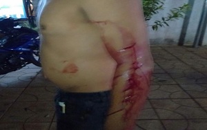 Bắt tạm giam đối tượng cố ý gây thương tích làm nhiều người bị thương