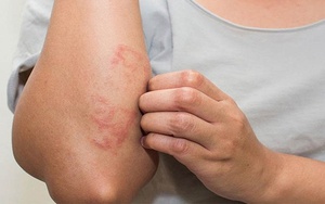 Người đàn ông bị dị ứng với rau củ quả: Căn bệnh lạ trên thế giới, chỉ cần ăn rau là buồn nôn, đau đầu suốt hai tuần