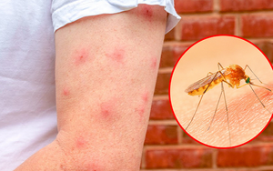 Giới khoa học khẳng định: Người hay bị muỗi cắn là do mùi cơ thể