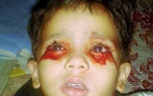 Đau xót cô bé 3 tuổi hàng ngày khóc ra máu