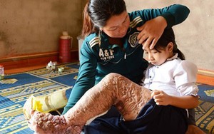 Viện nghiên cứu RTI của Mỹ khen ngợi Việt Nam thanh toán được bệnh chân voi