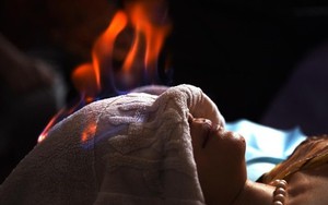 Sử dụng 'hỏa trị liệu' để làm đẹp liệu có an toàn?