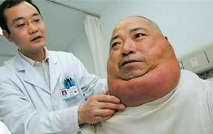 Bị đâm 7 nhát, vẫn thoát chết nhờ lớp mỡ quá dày