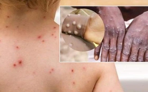 Tổng Giám đốc WHO cảnh báo sự lây lan của bệnh đậu mùa khỉ trên toàn cầu