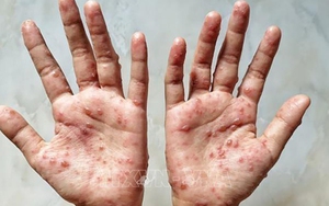 Bộ Y tế ban hành hướng dẫn chẩn đoán, điều trị và phòng bệnh đậu mùa khỉ ở người