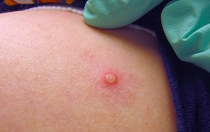 Ca mắc bệnh đậu mùa khỉ thứ hai tại TP. HCM không có nguy cơ lây nhiễm cộng đồng