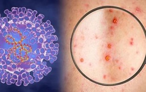Tổ chức Y tế Thế giới khuyến cáo về bệnh đậu mùa khỉ - thường thấy ở Trung Phi và Tây Phi