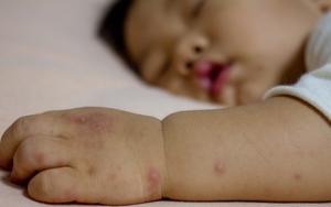 Kinh nghiệm chăm sóc trẻ mắc bệnh tay chân miệng, tránh biến chứng, nhanh hồi phục