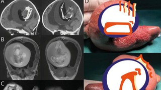 Mang thai đôi nhưng chỉ sinh một bé, 1 năm sau bố mẹ đưa con gái đi khám mới phát hiện sự thật đáng sợ nằm trong não