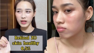 Dùng retinol bị kích ứng bong tróc, HH Đỗ Hà phải nhờ cậy cặp đôi serum + kem dưỡng để cứu vớt làn da