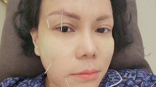 Việt Hương bị méo mặt, toàn thân phủ kín gần 50 cây kim châm cứu: Bác sĩ chỉ thói quen gây bệnh và cách phòng ngừa