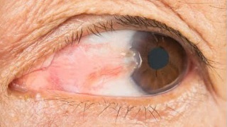 Những điều cần biết về bệnh mộng thịt