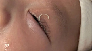 Mẹ cắt móng tay, dị vật văng vào mắt bé 2 tháng tuổi