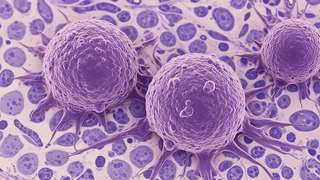 Xét nghiệm máu siêu nhạy của Johns Hopkins phát hiện ADN ung thư sớm 3 năm