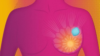AstraZeneca công bố đột phá của thuốc điều trị ung thư vú