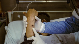 Bệnh nhân đậu mùa khỉ có thể truyền virus trước khi xuất hiện triệu chứng bệnh
