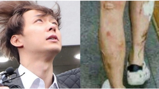 Rùng mình nhìn những vết loét, sưng rộp trên chân tay của Park Yoo Chun, hậu quả của nghiện ma túy đá