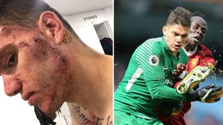 Fan Liverpool câm nín trước khuôn mặt biến dạng vì các mũi khâu của Ederson