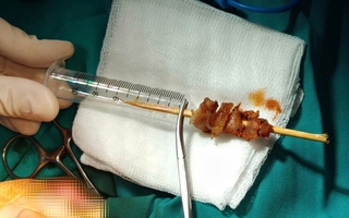 Thành công cứu bé gái bị que xiên thịt đâm xuyên nền sọ