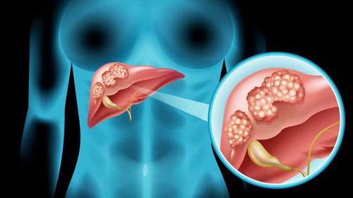 Người đàn ông 36 tuổi sự nghiệp đang nở rộ phát hiện bị 'thối gan' chỉ vì 1 thói quen nhỏ trước khi ngủ