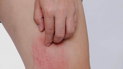 Hai bộ phận trên cơ thể ngứa ngáy là dấu hiệu của bệnh ung thư gan, nhiều người lại lầm tưởng là dị ứng