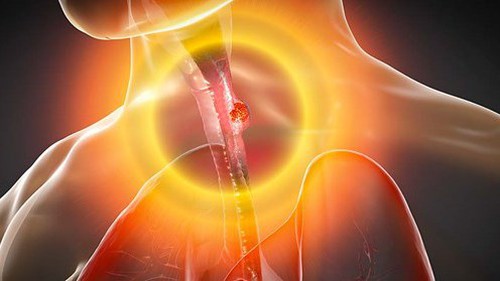 Những phát hiện khoa học mới giúp điều trị ung thư thực quản