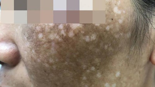 Học bí quyết trị nám bằng lá trầu trên Tik Tok, 4 người phụ nữ nhận hậu quả nặng nề