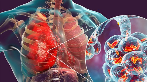 Cảnh báo nguy cơ mắc ung thư phổi gia tăng ở nhóm không hút thuốc