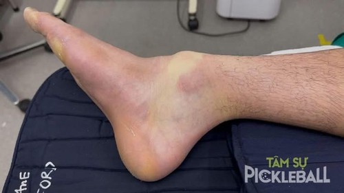 Choáng với hình ảnh cổ chân một thanh niên sau 4 giờ chơi pickleball liên tục