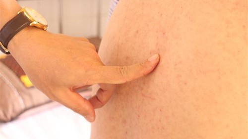 Ghi nhận bệnh Sởi ở nhiều người trưởng thành, đã có ca tử vong