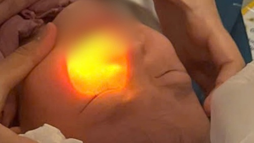 Bé gái 4 tuổi bỏng mắt vì cồn rửa tay khi đi du lịch ở Đà Lạt