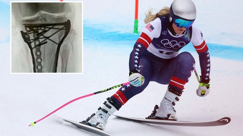 'Nữ hoàng trượt tuyết' Lindsey Vonn công bố hình ảnh X-quang kinh hoàng sau 5 ca phẫu thuật vì cú ngã ở Olympic mùa Đông