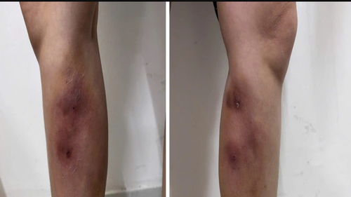 Nguy cơ hoại tử do tiêm Filler làm thẳng chân tại nhà