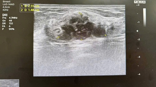 Phát hiện ung thư vú khi cơ thể vẫn "khỏe mạnh": Chuyên gia khuyến cáo tầm quan trọng của tầm soát sớm.