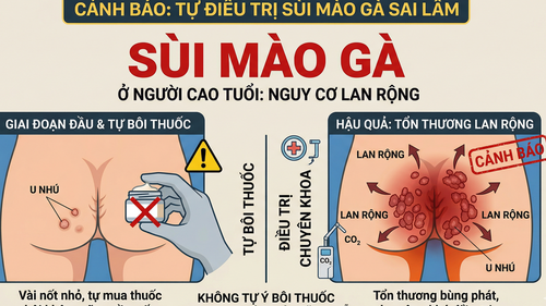 Sùi mào gà ở người cao tuổi: Xấu hổ tự điều trị hay đối mặt nguy cơ lan rộng khó lường?