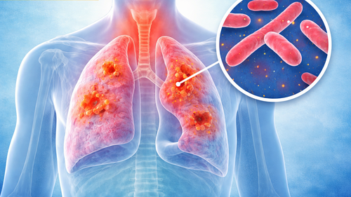 Phát hiện lao gắn với khám sức khỏe định kỳ cho mỗi người dân