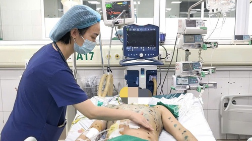 Thuỷ đậu ở người lớn: Khi căn bệnh “lành tính” đối mặt với hàng loạt biến chứng nguy hiểm